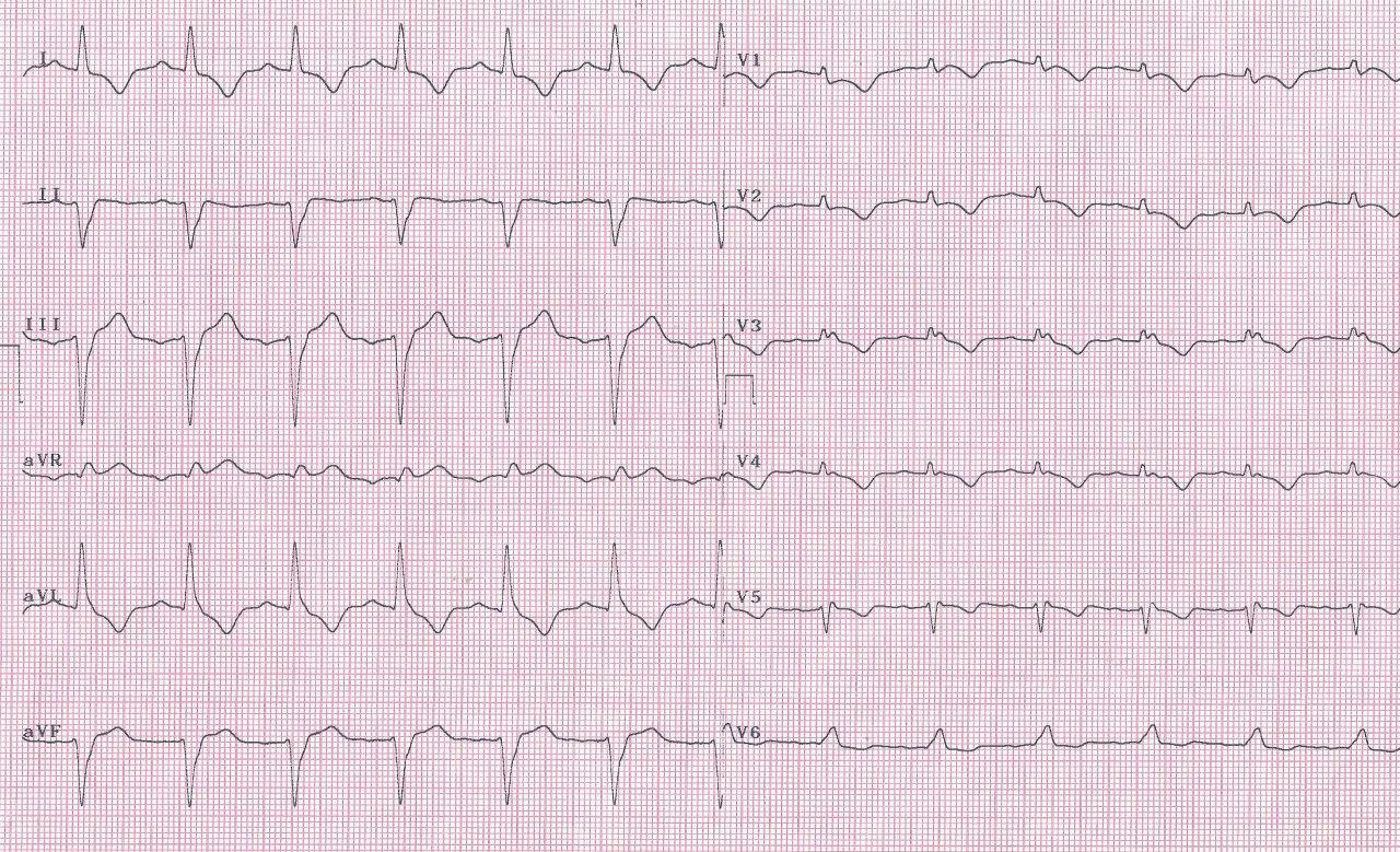 Mujer de 87 años con episodios presincopales por presencia de bloqueo trifascicular constituyendo un Síndrome de Rosenbaum