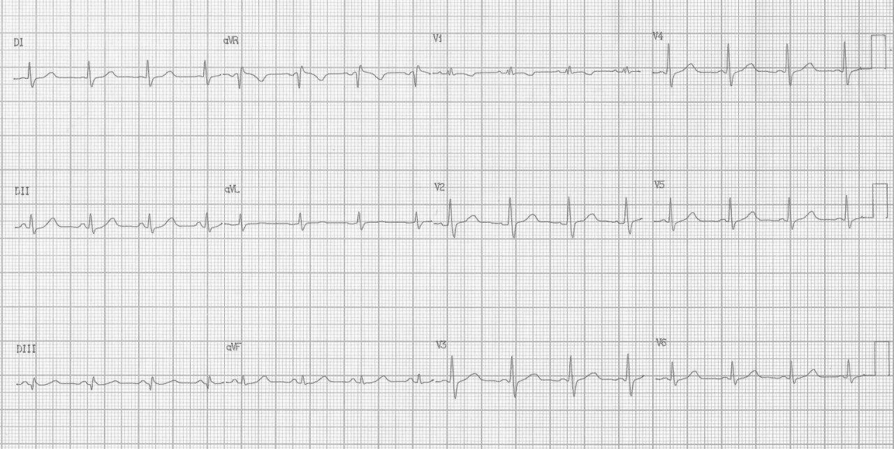 Patrón trifásico en VI (BIRD) en 3 pacientes con CIA, BIRD inocente y Síndrome de Brugada respectivamente