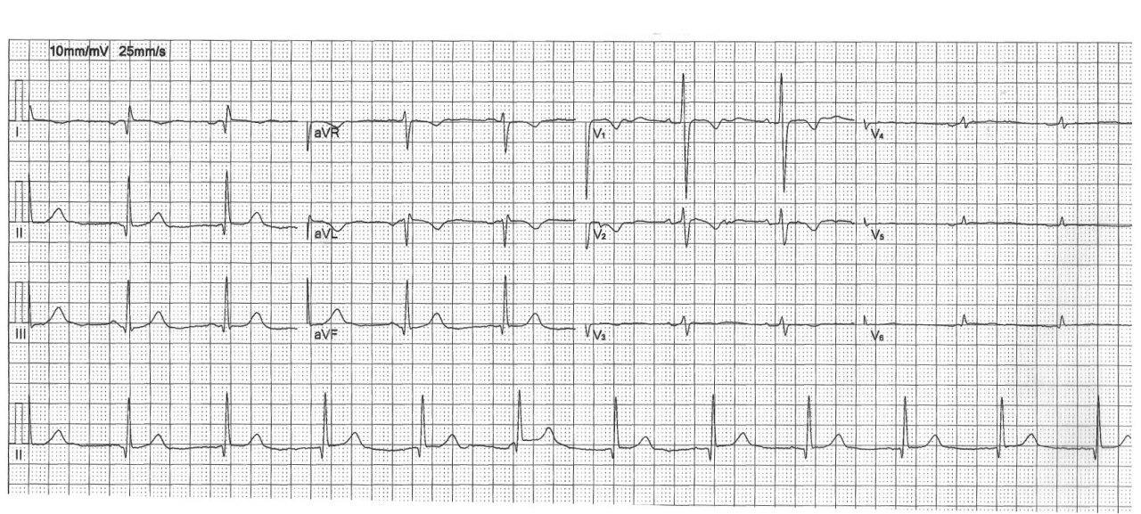 Mujer adulta asintomática portadora de dextrocardia; ECGs con electrodos en posición habitual e invertida respectivamente
