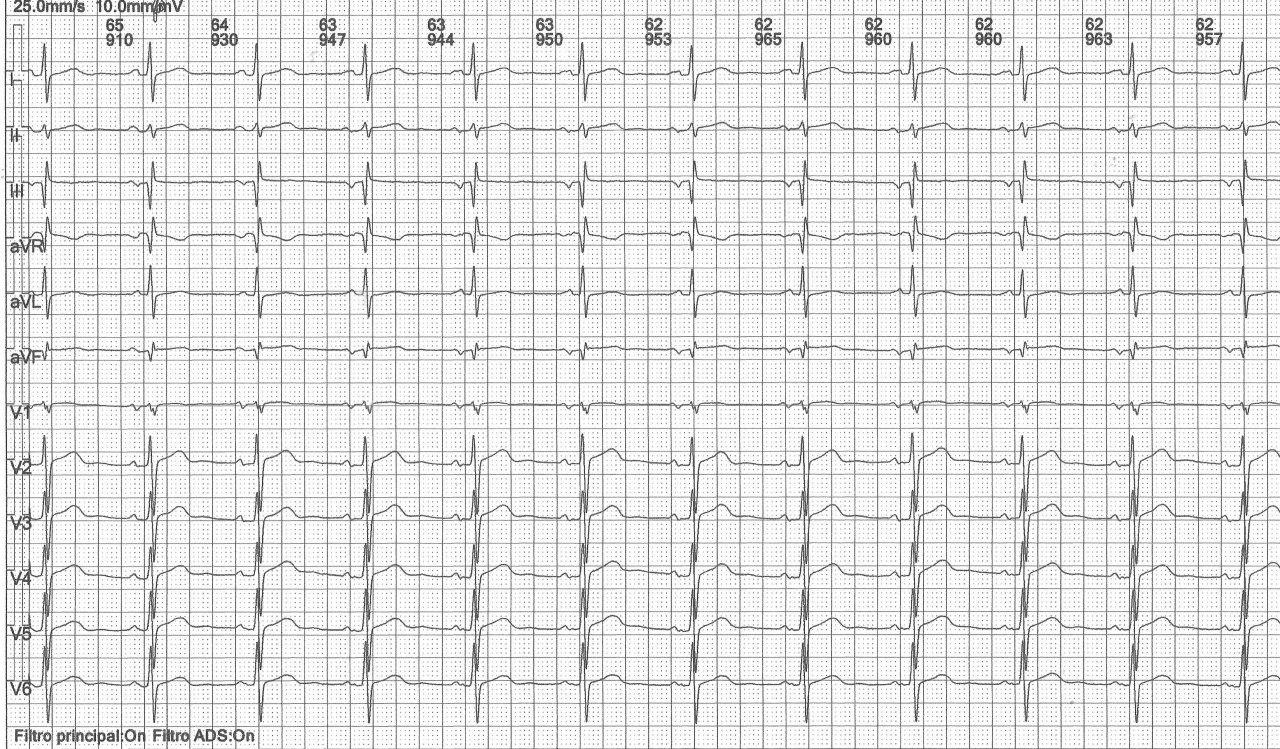Hombre de 56 años con antecedentes de infección pulmonar hace años que presenta extrasístoles auriculares y TA en el Holter con secuela de miocarditis en RNM