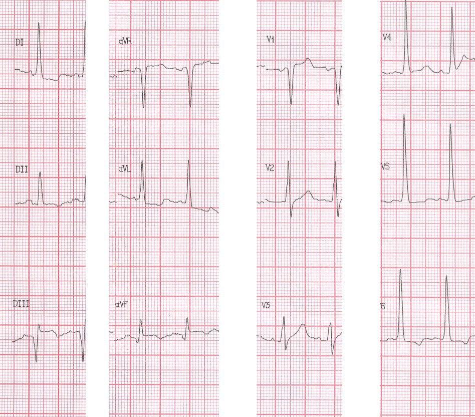 Hombre de 77 años portador de WPW, con antecedente de IAM  e implante de stent 5 años antes que cursa con nuevo infarto de cara inferior