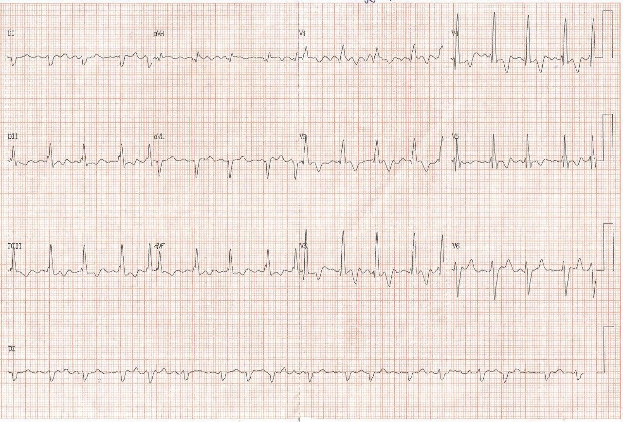 Mujer adulta portadora de CIA-OS con HTP que es operada