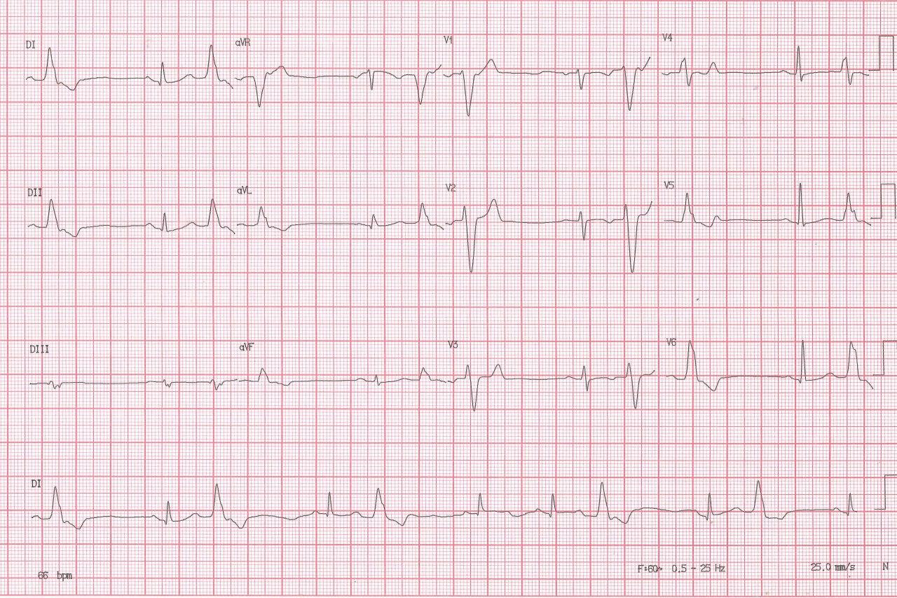 ECG de rutina de mujer de 41 años asintomática sin antecedentes familiares que presenta frecuentes extrasístoles ventriculares originadas en VD con sospecha de DAVD