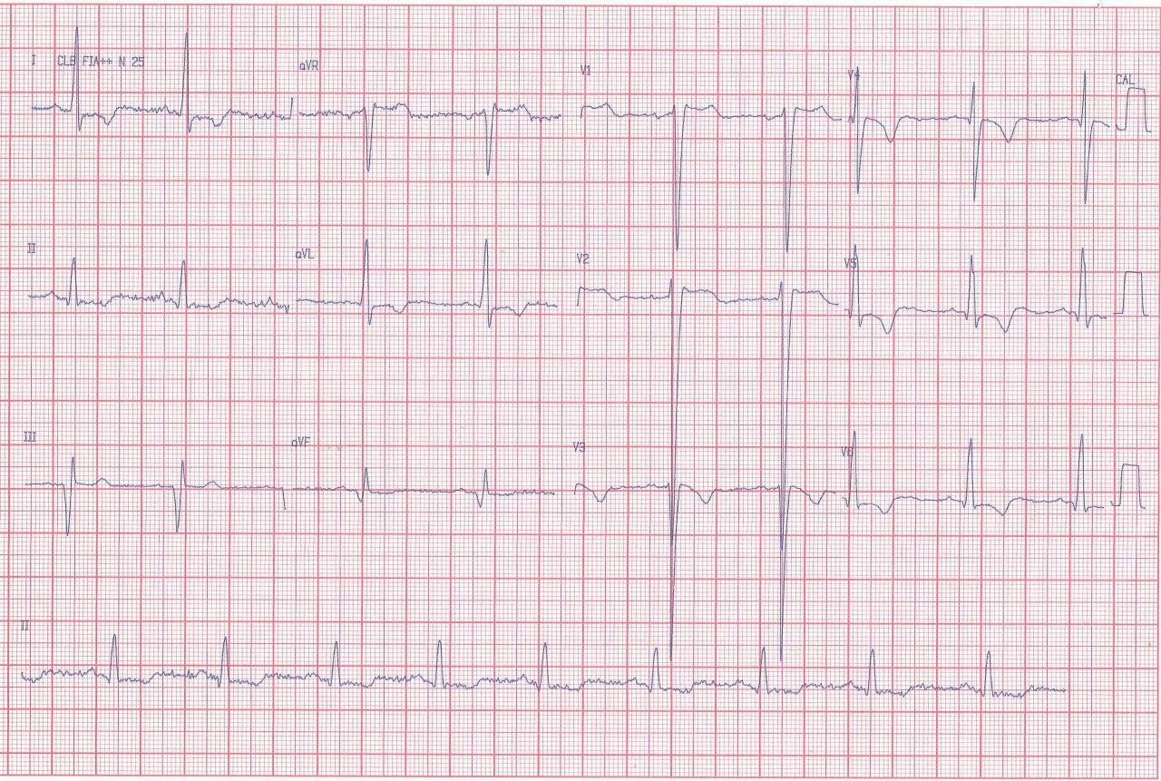 Hombre de 44 años que presenta disnea y síncopes por ser portador de miocardiopatía hipertrófica obstructiva y puente muscular coronario