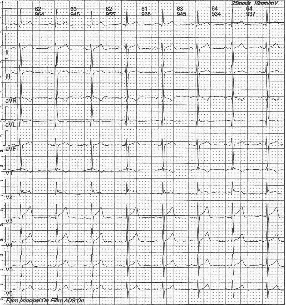 Paciente de 61 años que presenta bloqueo bifascicular y FAP por pectum excavatun