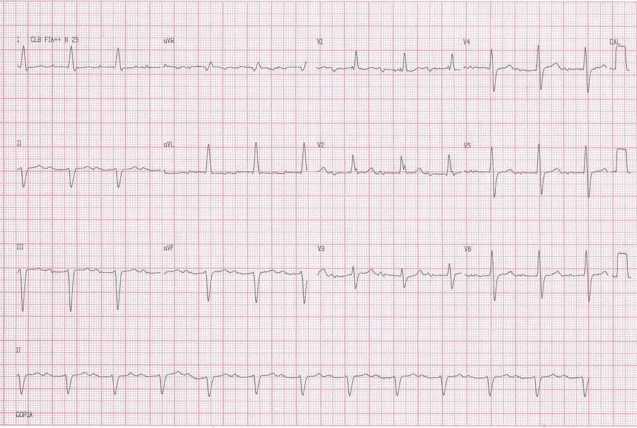 Paciente de 77 años, hipertenso y diabético que cursa con angor prolongado con aumento de troponina, que presenta imagen de bloqueo trifascicular en el ECG por compromiso de la DA proximal