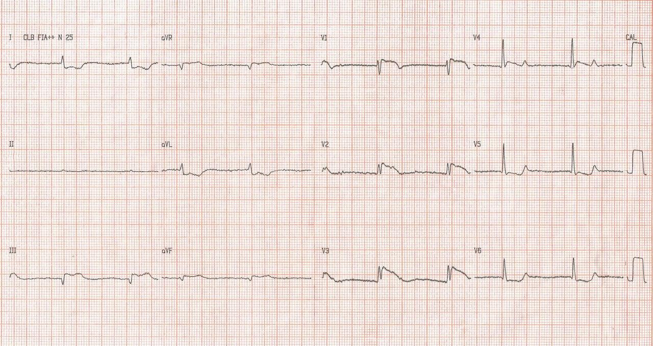 Masculino de 84 años con factores de riesgo presenta angor prolongado por infarto agudo de VD que simula infarto de cara anterior con BRD y ritmo de la unión por oclusión trombótica de la CD
