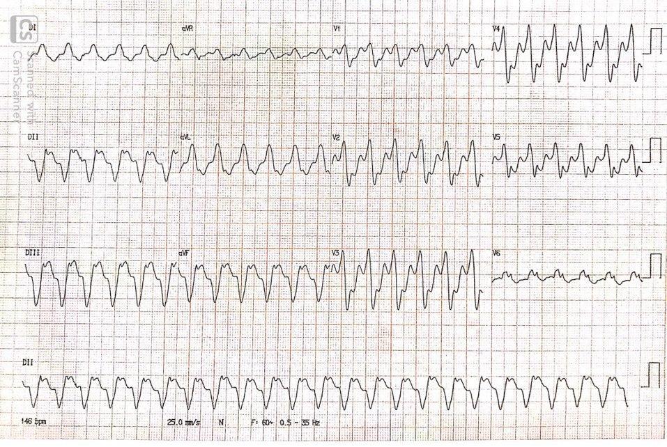 Hombre de 65 años con historia previa de IAM que consulta por angor prolongado constatándose TV que muestra ondas Q similares a las del Ritmo sinusal, con reversión espontánea