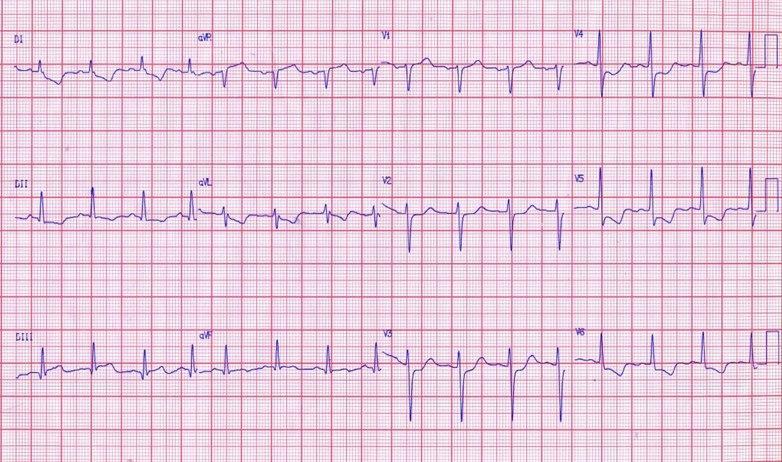 Paiente que cursa con IAM de cara inferior e isquemia circunsferencial por compromiso de CD y TCI