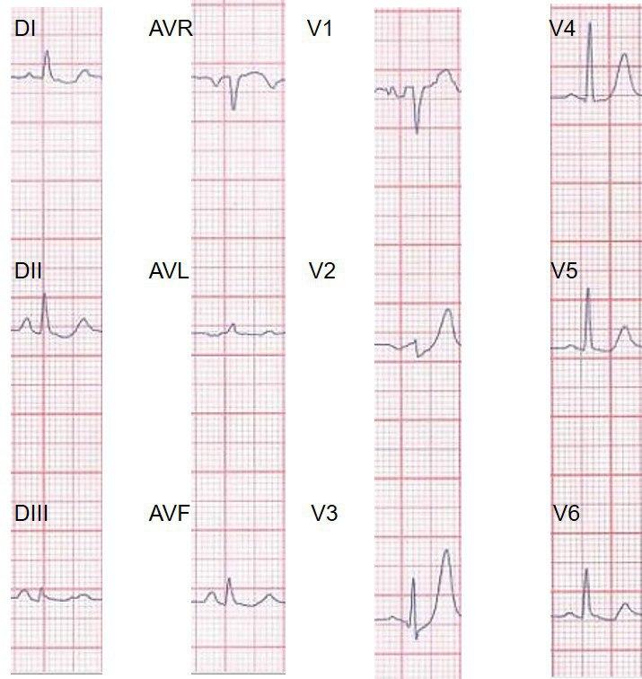 Masculino de 51 años con angor prolongado que presenta patrón de Winter en el ECG que evoluciona a IAM anterior por compromiso de la DA proximal, con compromiso auricular