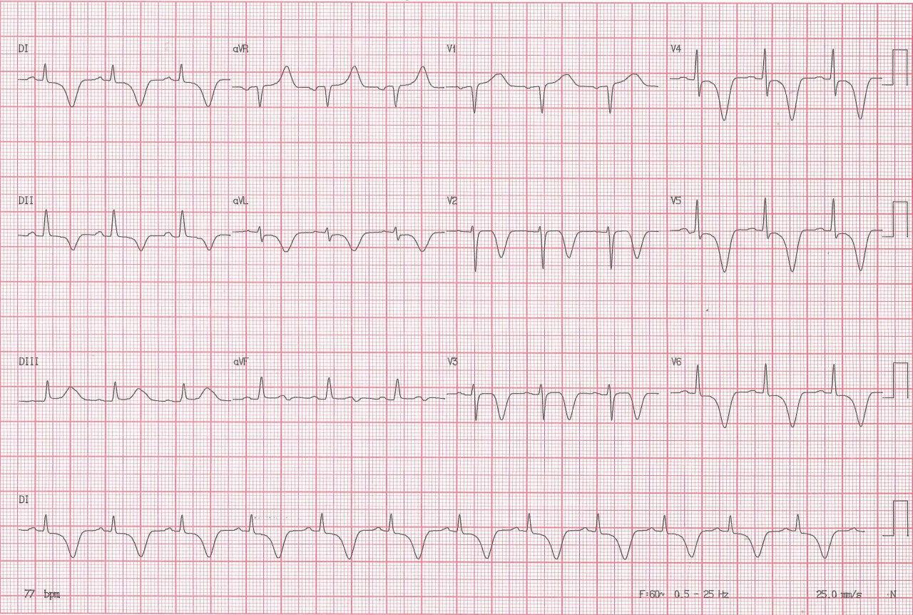 Mujer hipertensa que presenta cefalea repentina asociada a vómitos y parestesia izquierda que ingresa con pérdida del sensorio y hallazgo de troponina positiva con hipoquinesia medio-apical por síndrome de Tako tsubo secundario a hemorragia cerebral