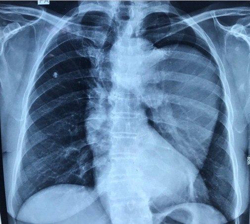 Hombre hipertenso de 74 años con dolor retroesternal irradiado a dorso por disección aórtica que evoluciona a dilatación aneurismática entre arco aórtico y aorta descendente