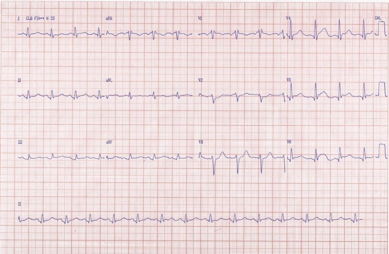 Joven de 23 años con pérdida súbita del conocimiento detectándose FV que es revertida exitosamente a consecuencia de cuadro de miocarditis aguda