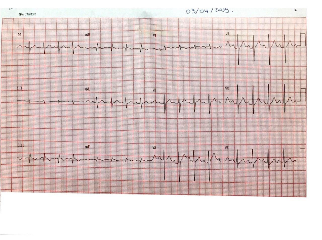 Paciente de 20 años con cuadro de fiebre, astenia, disnea, adinamia, mialgias con severa hipoxemia con un infiltrado alveolointersticial bilateral, y evolución a insuficiencia renal y hepática, constatándose serología reactiva para leptoespirosis con franca mejoría con tratamiento antibiótico