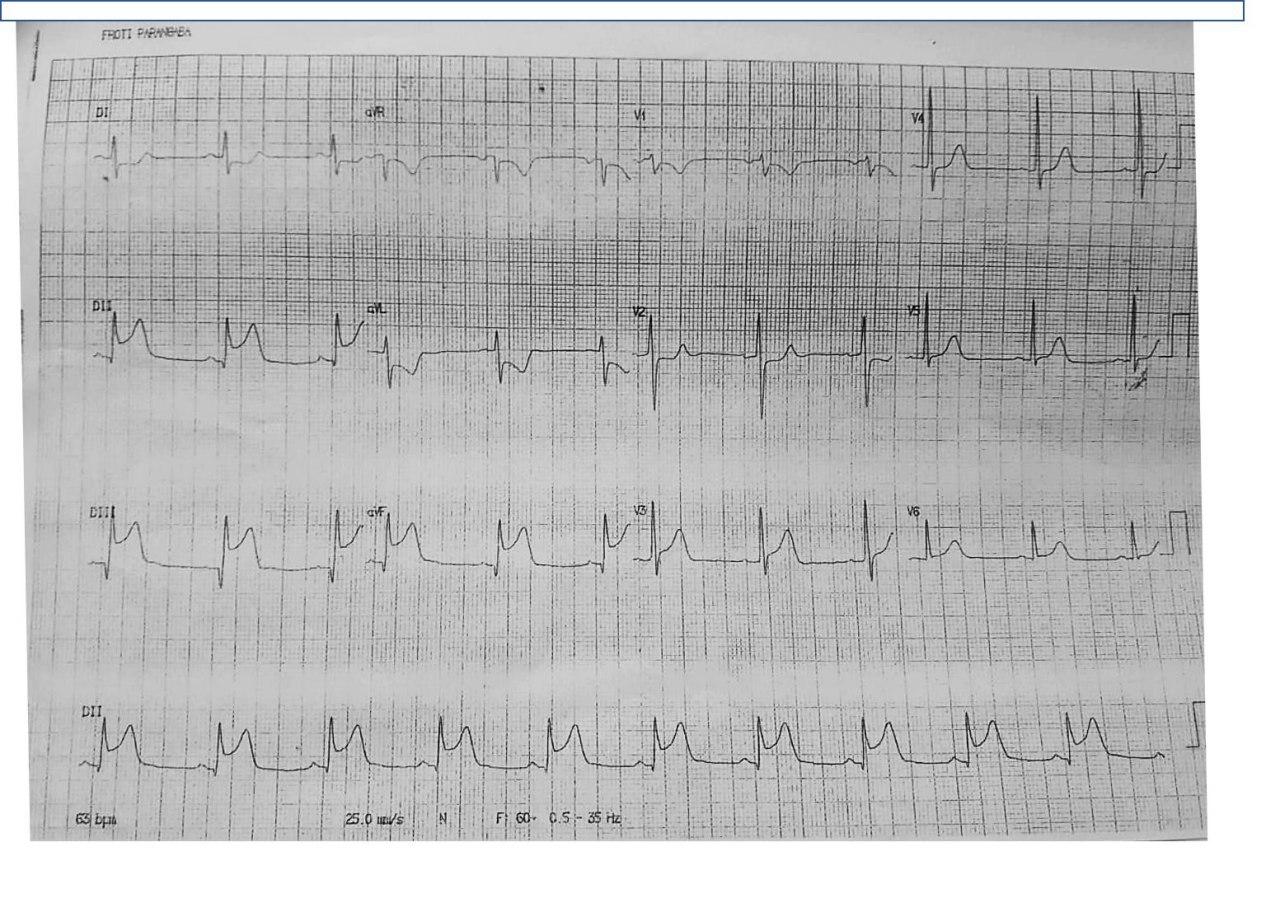 Hombre de 58 años con angor prolongado y compromiso hemodinámico con presencia de soplo holosistólico por infarto inferior complicado con CIV