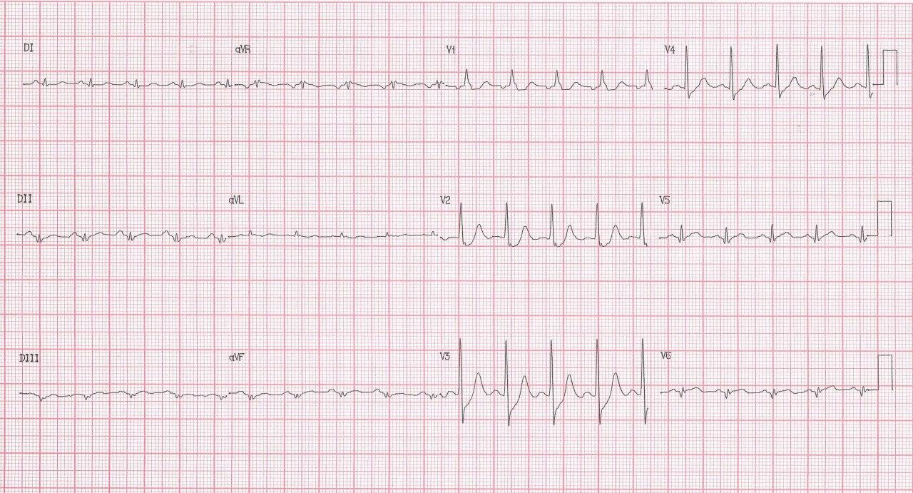 Hombre de 55 años hipertenso con episodio de angor prolongado debido a IAM lateral (ex dorsal) por compromiso de la Cx