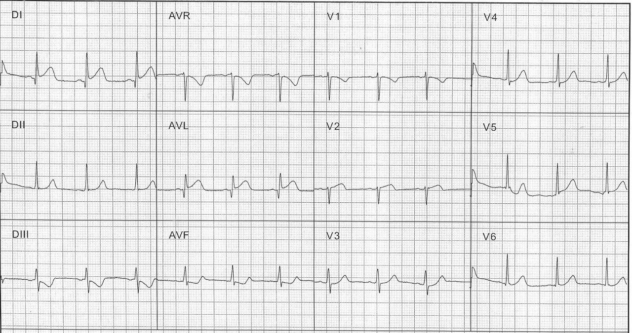 Paciente de 48 años con angor prolongado que presenta imagen de IAM lateral por compromiso de arteria 1º diagonal