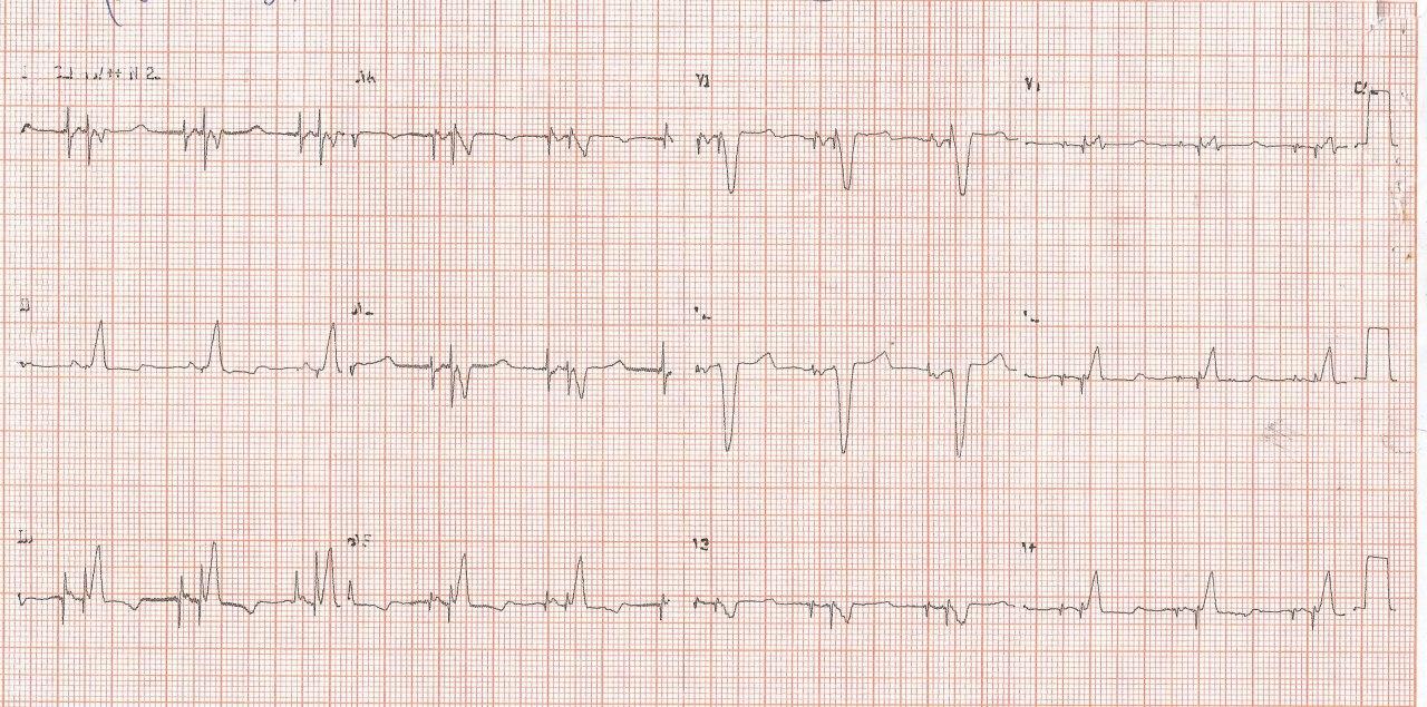 Paciente con Enfermedad de Chagas y portador de marcapasos que manifiesta dolor precordial que remeda angina de pecho y que presenta compromiso microvascular con arterias coronarias epicárdicas normales y presencia de isquemia en estudio de medicina nuclear