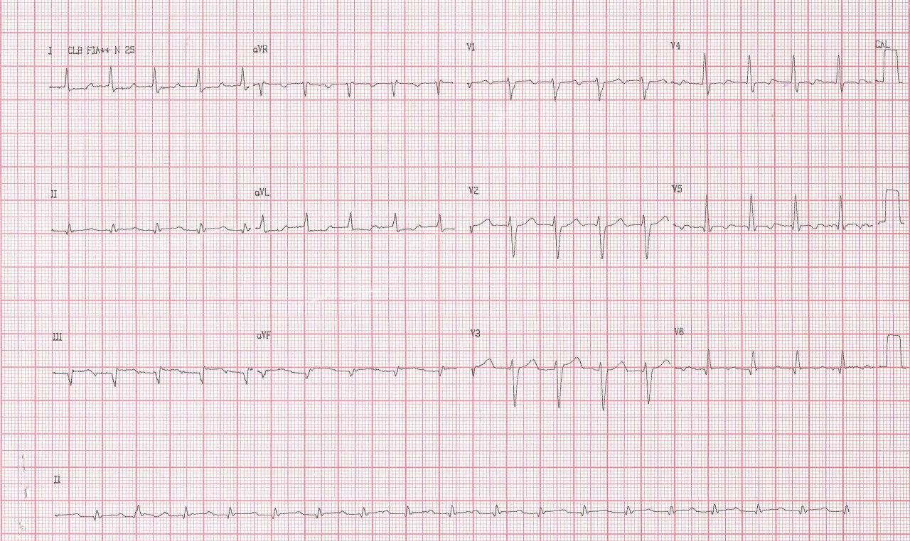 Hombre de 64 años con angor prolongado por IAM inferior que presenta TA 2:1 observándose fenómeno de Bix por compromiso de arteria marginal de la Cx