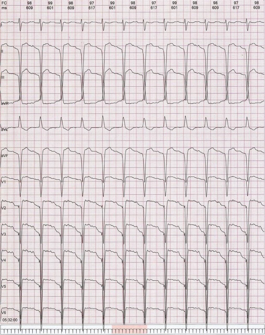 Holter de hombre hipertenso que presenta palpitaciones debidas a aleteo auricular