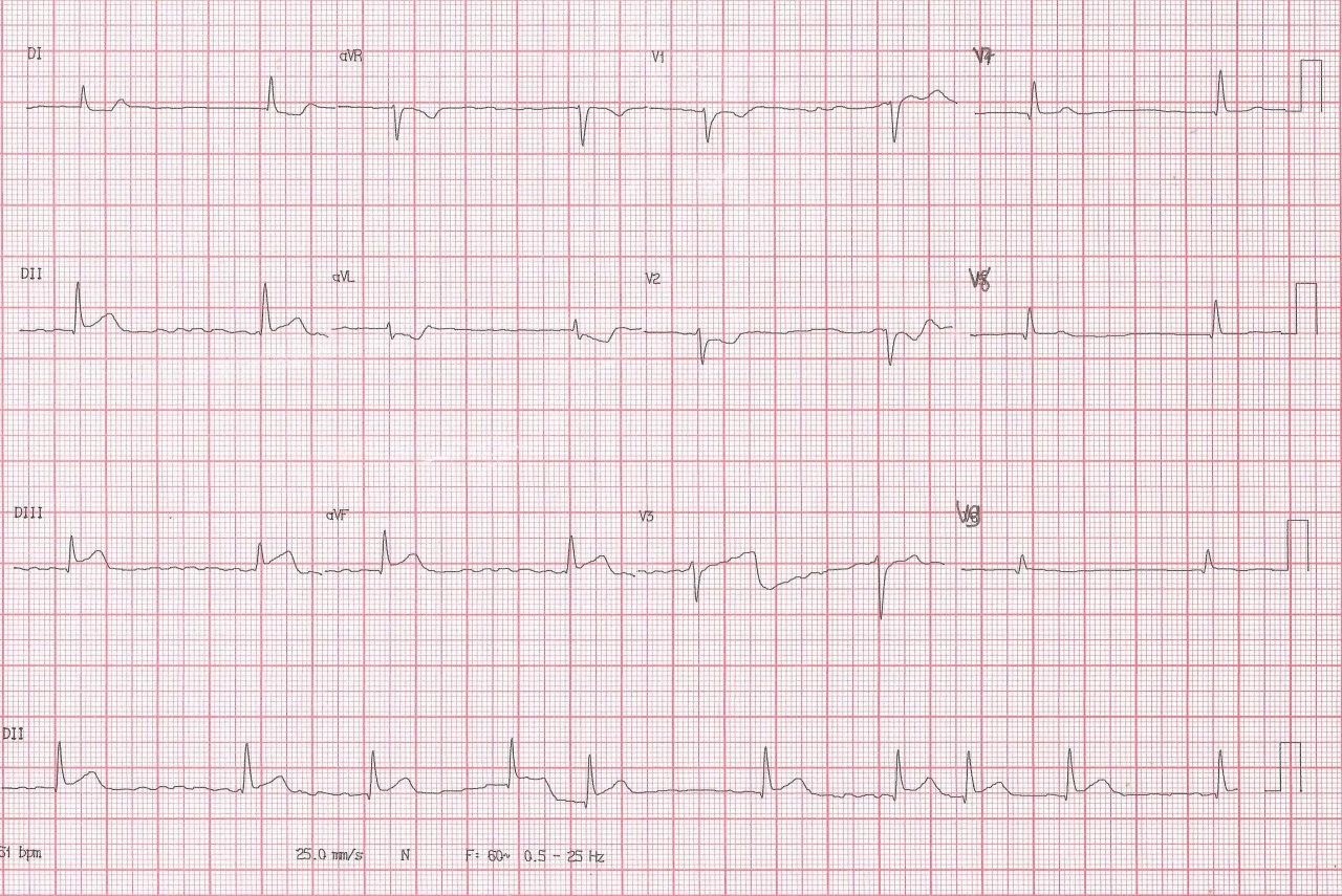 Paciente que en la evolución de un SCA cursa con FA por compromiso de ramo auricular que nace de arteria ventricular posterior que es revascularizada con recuperación de RS