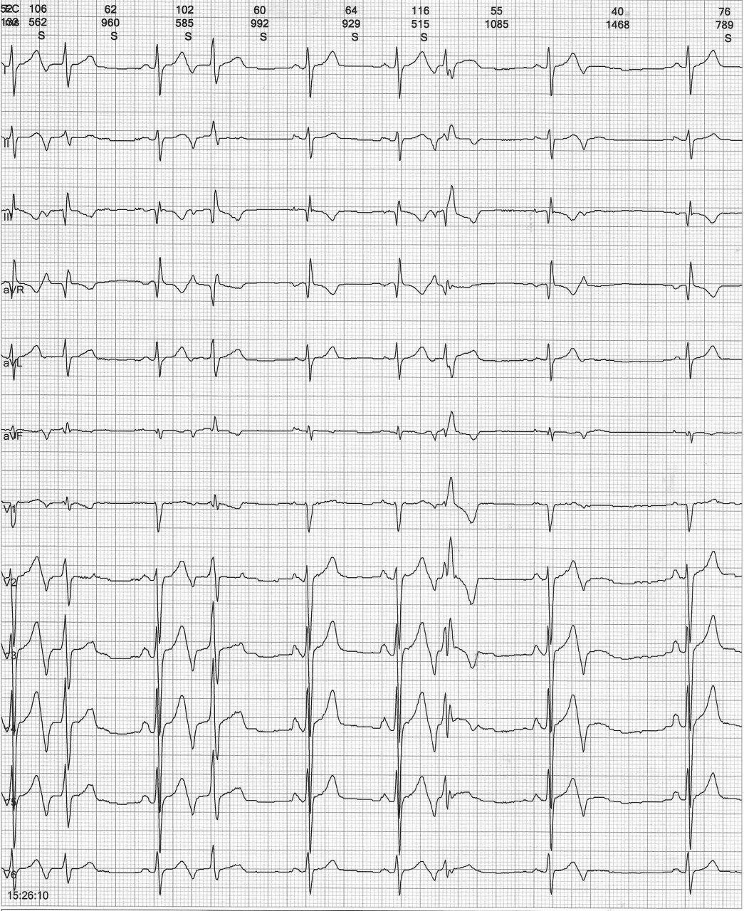 Joven asintomático de 19 años que presenta extrasístoles auriculares bloquedas y con conducción aberrante en presencia de aneurisma de séptum interauricular