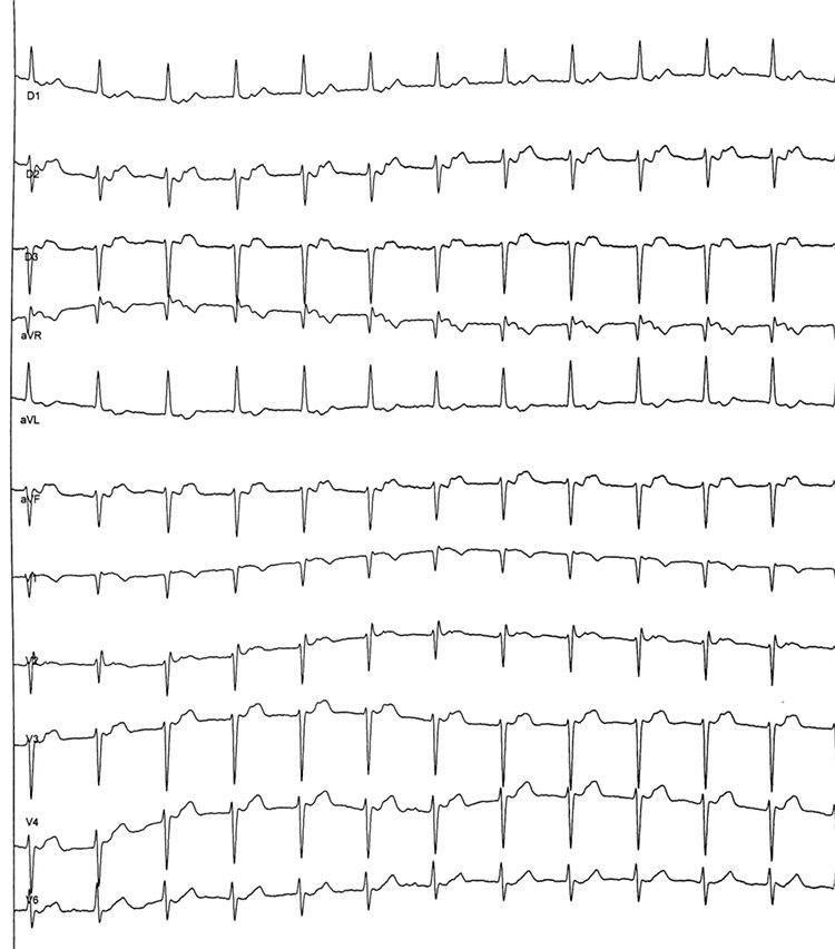 Mujer de 80 años con mareos frecuentes que presenta TRIN por doble vía nodal lenta – rápida que responde al suave MSC con pausas prolongadas por hipersensibilidad del seno carotídeo