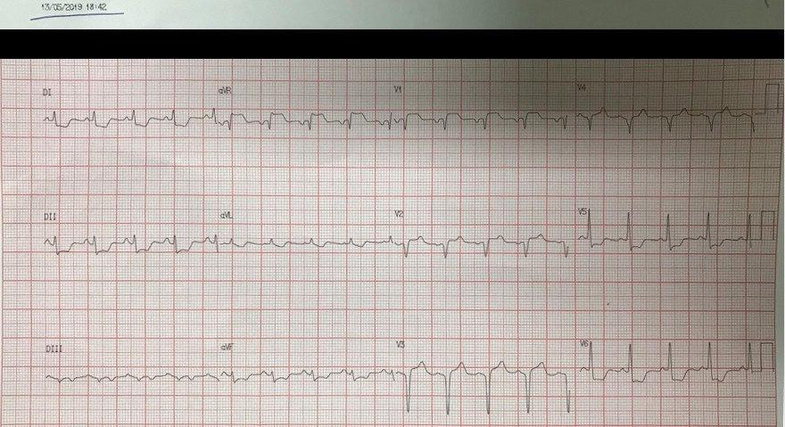 Mujer de 61 años con angor prolongado y disnea por enfermedad coronaria de tres vasos