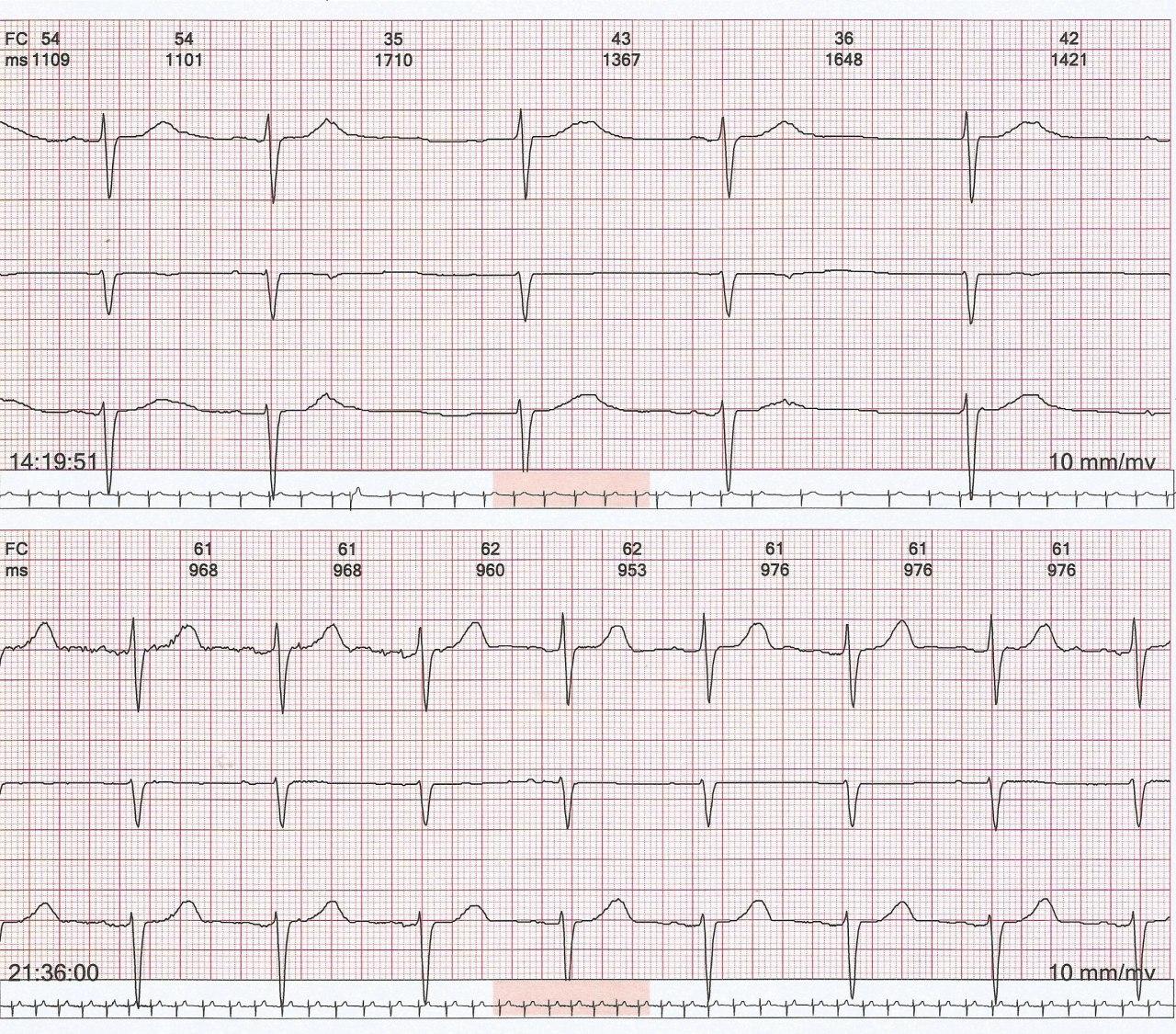 Holter de paciente con FA paroxística que muestra extrasístoles auriculares bloquedas con fenómeno de P sobre T y extrasístoles originadas en venas pulmonares que desencadenan la fibrilación