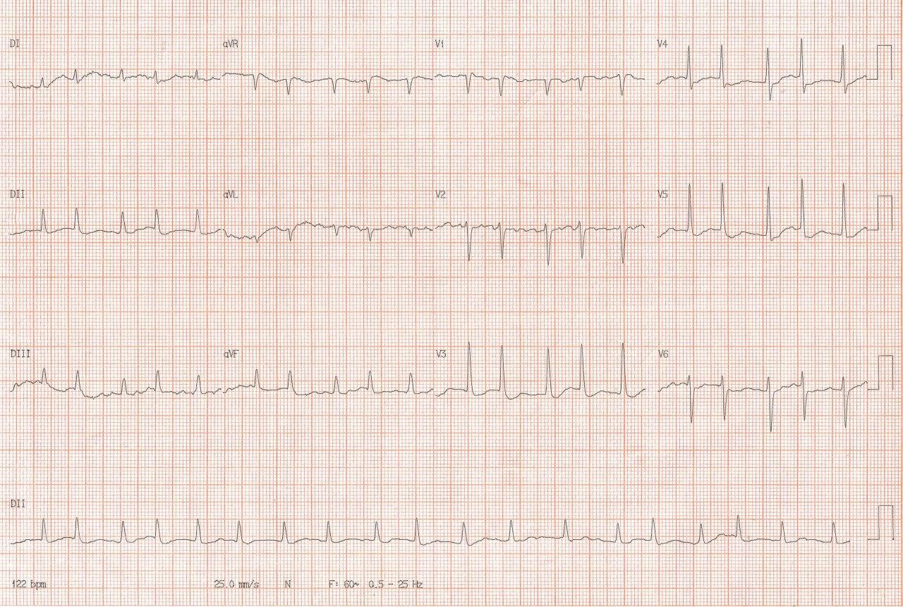 Mujer de 50 años portadora de cardiopatía reumática que refiere disfagia a sólidos y disfonía por megaaurícula izquierda que comprime el esófago y el nervio laríngeo recurrente izquierdo