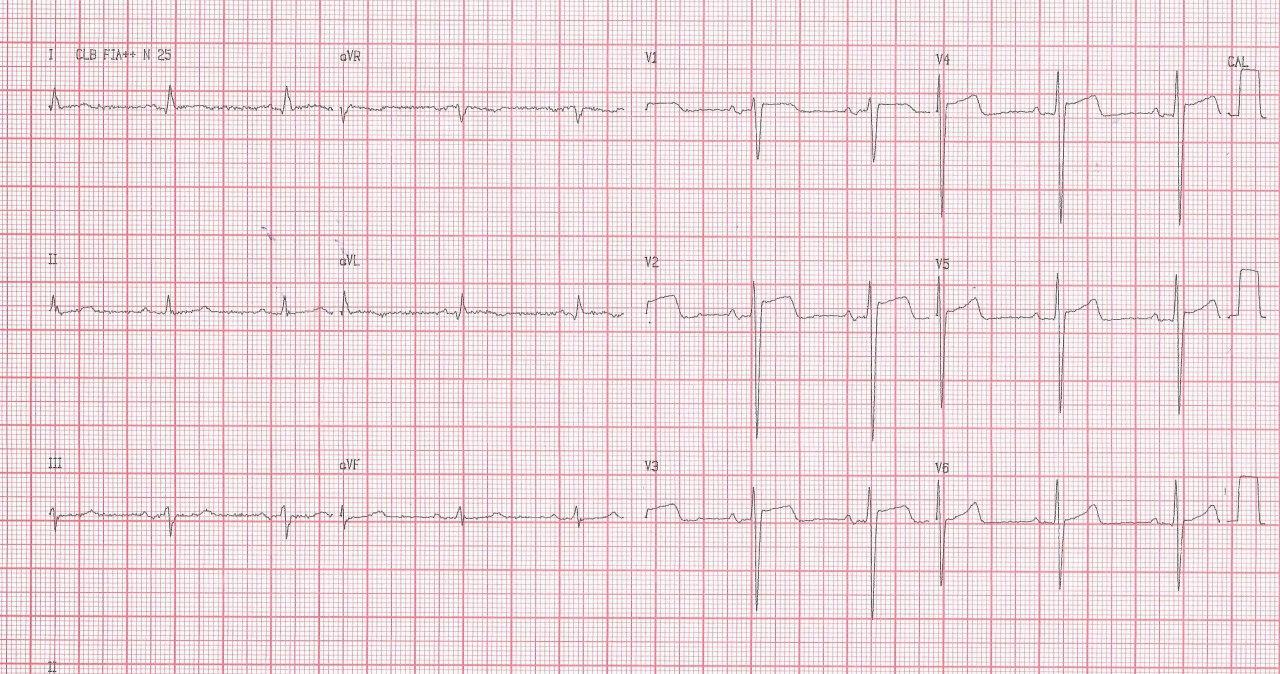 Paciente de 49 años hipertenso severo con cefaleas, disnea y visión borrosa, que presenta severa HVI concéntrica, CCG normal expresión de miocardiopatía hipertensiva