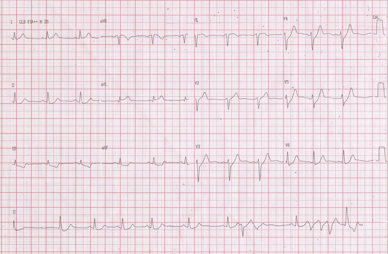 Hombre de 66 años con factores de riesgo que presenta angor prolongado cuyo ECG presenta patrón de Winter por obstrucción con trombo en la DA