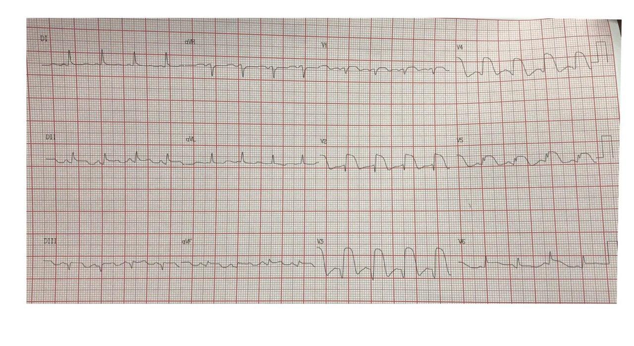 Mujer de 77 años, hipertensa y diabética que presenta iAM anterior por compromiso de DA que se complica con una CIV