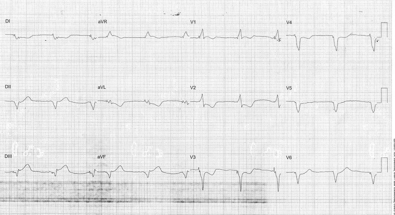 Hombre de 75 años con antecedente de implante de stent y CDI biventricular que presenta episodio de angor prolongado, con puntaje de 3 según los criterios de Sgarbossa, por oclusión de CD distal con trombo