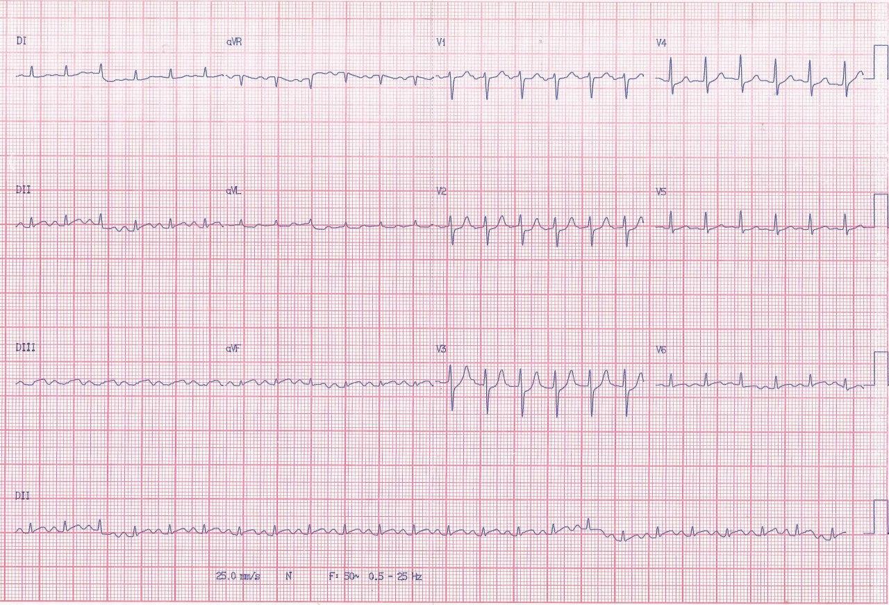 Hombre de 62 años hipertenso y diabético que presenta angor prolongado irradiado a dorso por SCA que compromete arteria Cx que presenta suboclusión con trombo