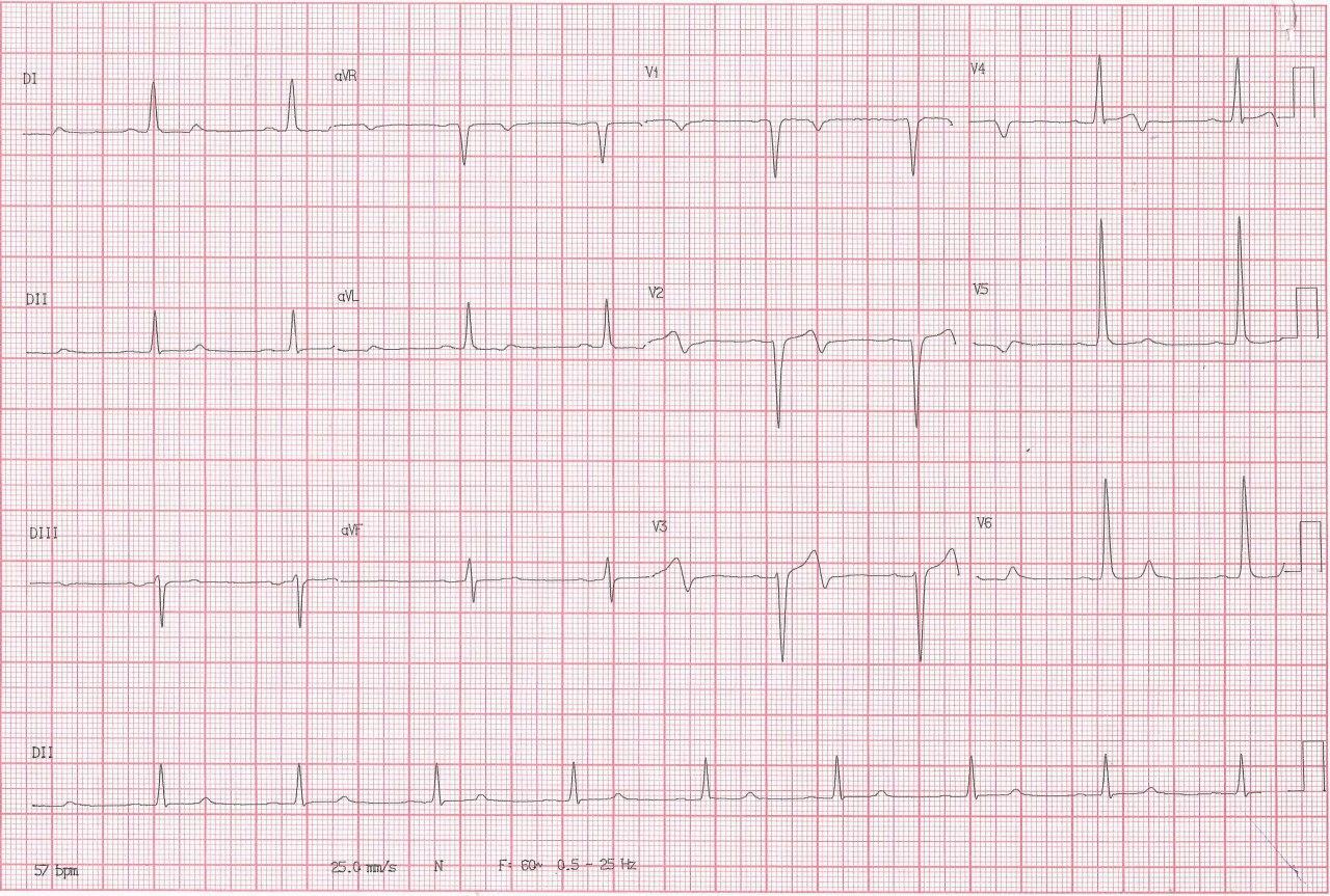Hombre de 63 años portador de insuficiencia aórtica que consulta por dolor precordial con troponina negativa que presenta patrón ECG de pseudo Wellens con CCG normal y presencia de HVI