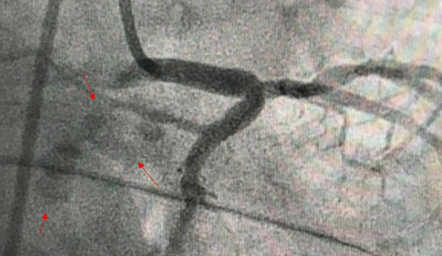 Hombre portador de estenosis aórtica calcificada que presenta episodios sincopales por BAVC por coexistencia de enfermedad de Lev debido a calcificación del sistema de conducción