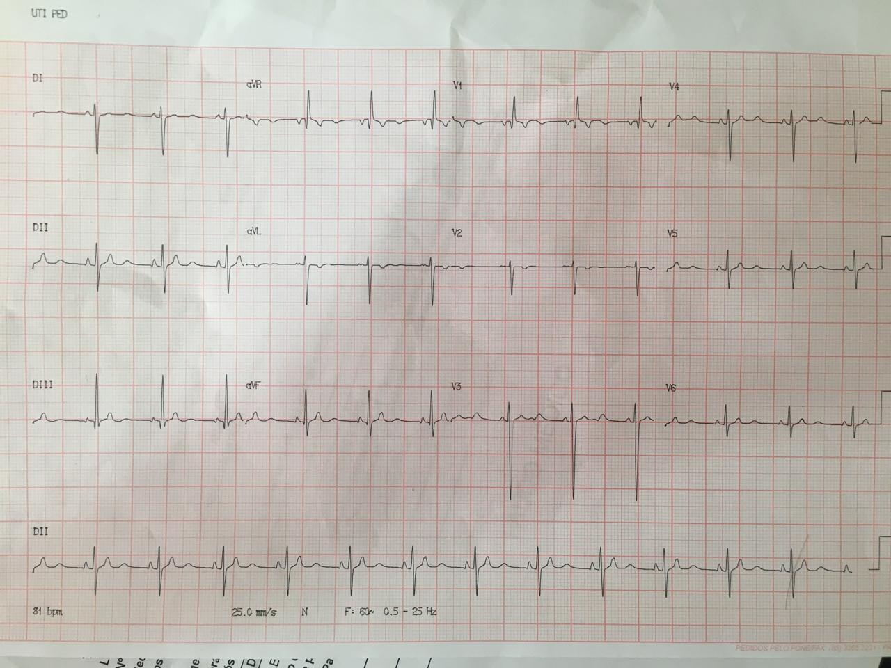 ECG de niño recién nacido que presenta extrasístoles auriculares bloqueadas