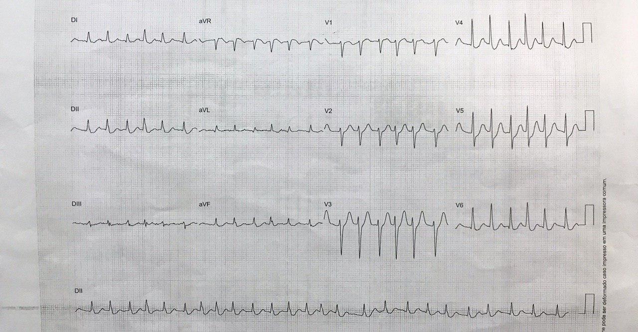Mujer de 71 años portadora de prolapso valvular mitral que presenta súbito dolor precordial y disnea por ruptura de cuerdas tendinosas
