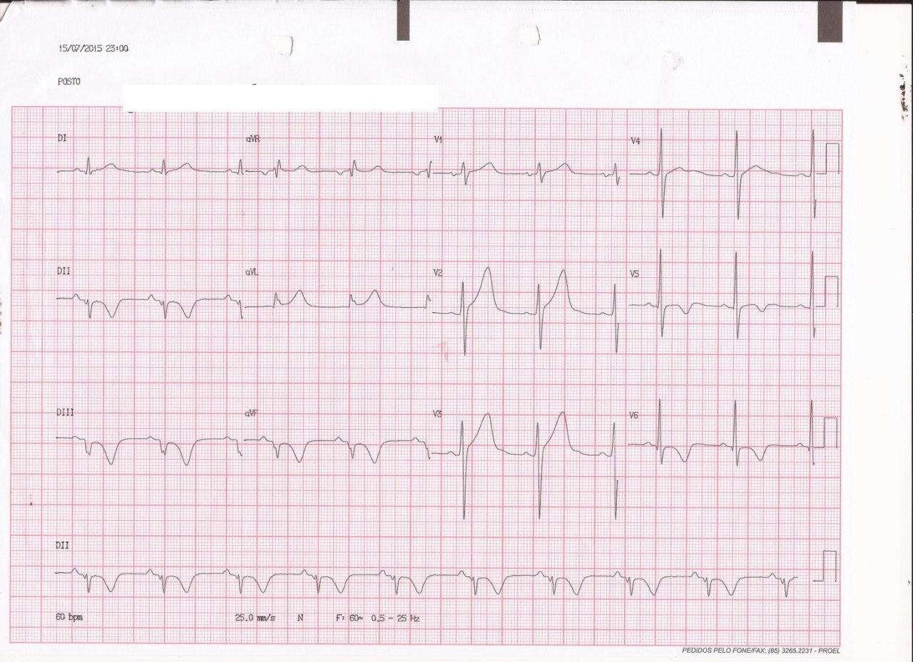 Paciente de 28 años con palpitaciones originadas en TV fascicular que determina la presencia de ondas T negativas por memoria cardíaca en el ECG con ritmo sinusal