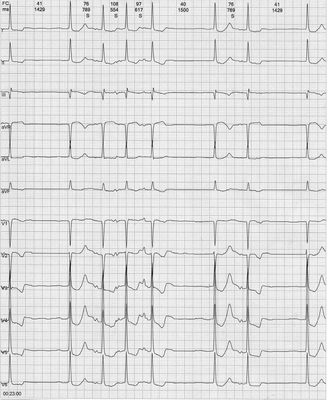Mujer de 90 años con síntomas de intoxicación digitálica que presenta una taquicardia auricular con BAV variable