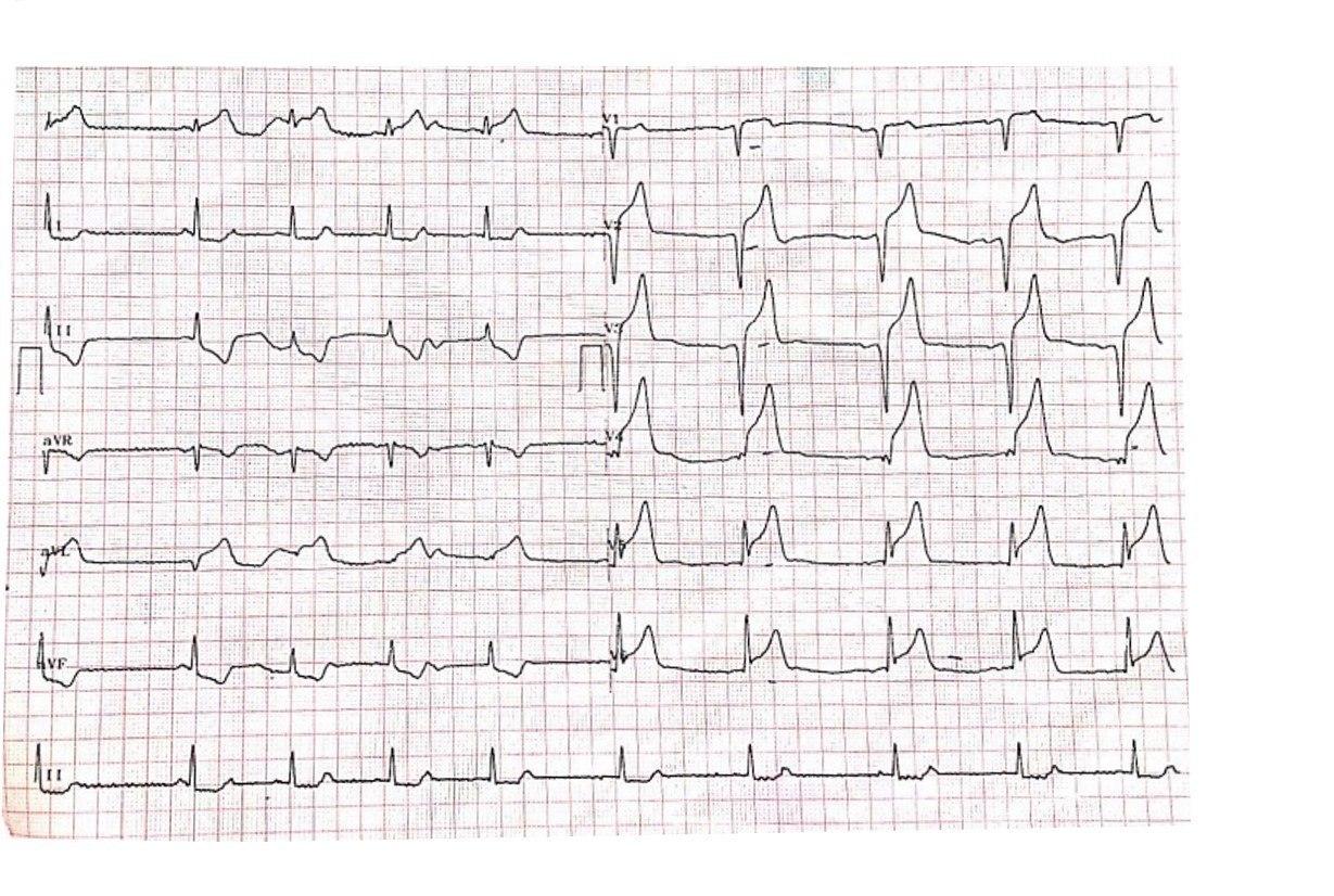 Joven de 39 años que a posteriori de un entrenamiento para el cuál usó termogénicos en base a cafeína presenta oclusión total de DA con trombo