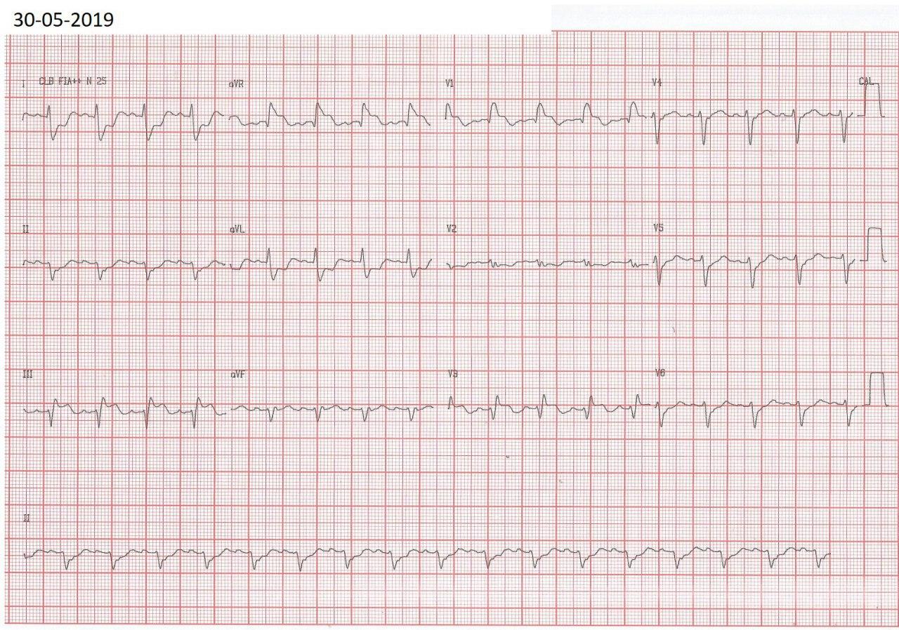 Mujer de 45 años con fiebre, mialgias y disnea progresiva, con aumento de troponinas, con ECG simulando SCA, con CCG normal, por miopericarditis aguda