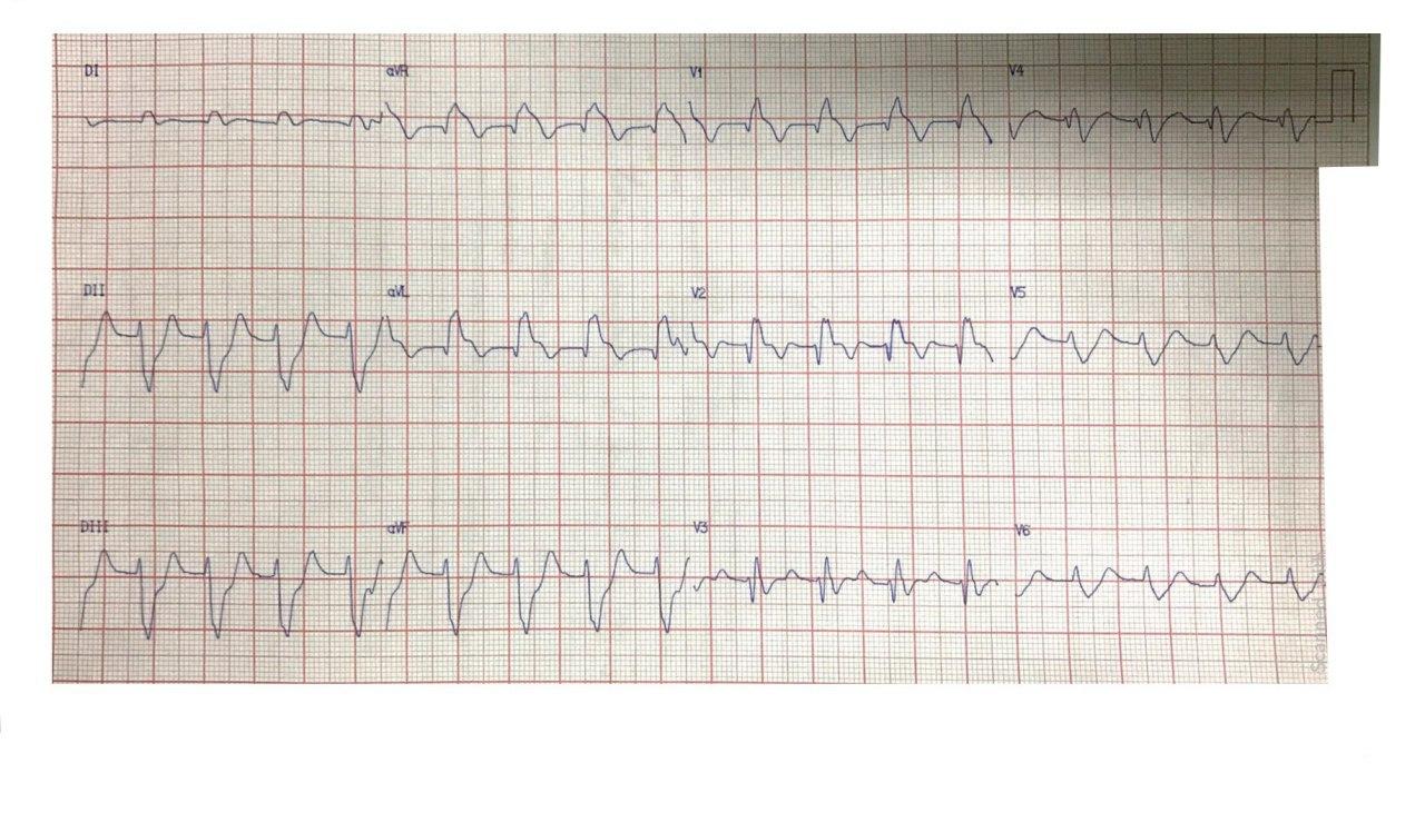 Paciente de 48 años con SCA e inestabilidad hemodinámica por compromiso de TCI