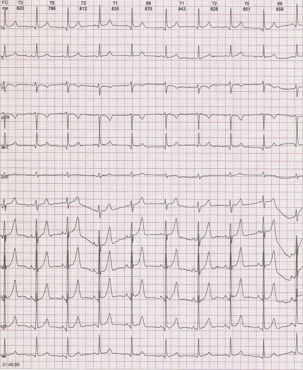 Mujer de 36 años con palpitaciones en quién se detecta preexcitación intermitente
