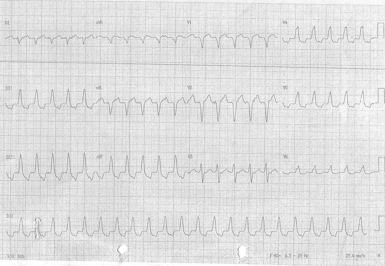 Hombre de 63 años con dolor punzante precordial y sudoración que presenta taquicardia de QRS ancho cuyo origen se halla en el séptum interventricular