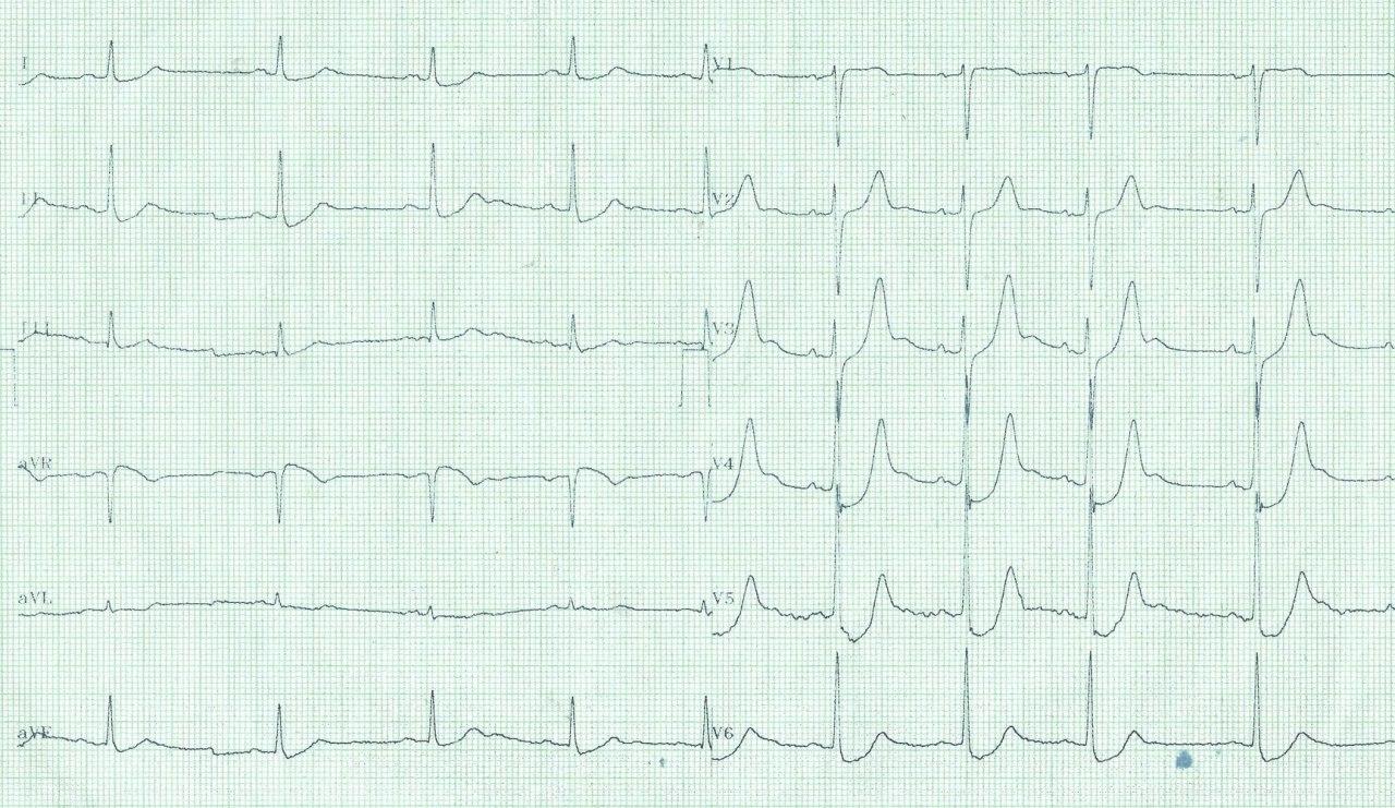Paciente de 59 años con episodio de angor prolongado que presenta patrón de Winter en el ECG por compromiso de arteria Cx con DA normal