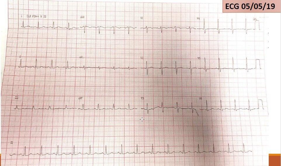 Mujer de 46 años con episodios de síncopes recurrentes precedidos por palpitaciones debidos a presencia de TV monomorfa sostenida de Gallavardin