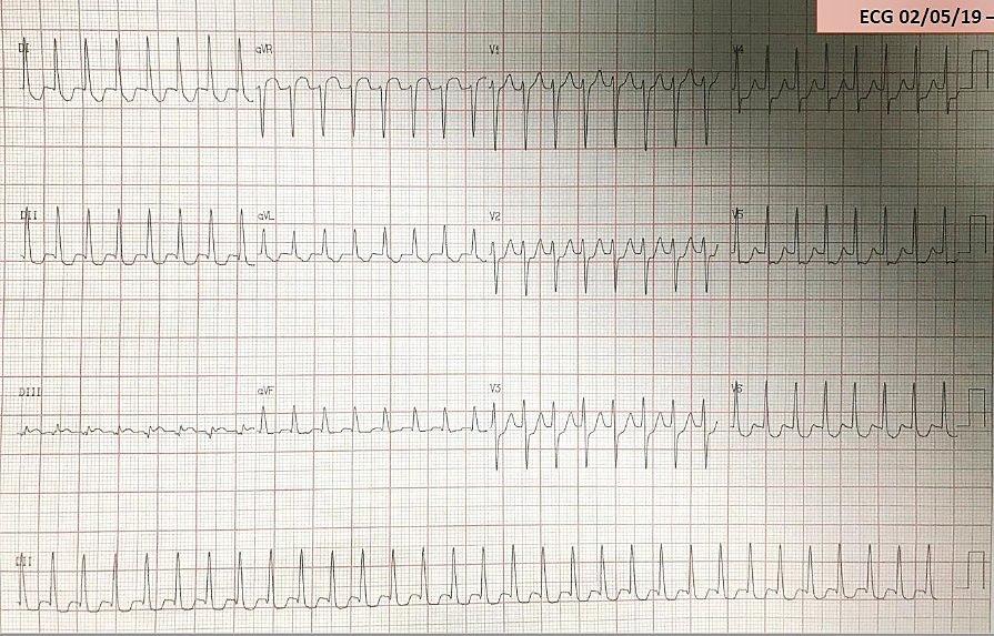 Paciente masculino de 30 años con palpitaciones frecuentes por desarrollar TRAVO y vía accesoria lateral izquierda que se ablaciona exitosamente