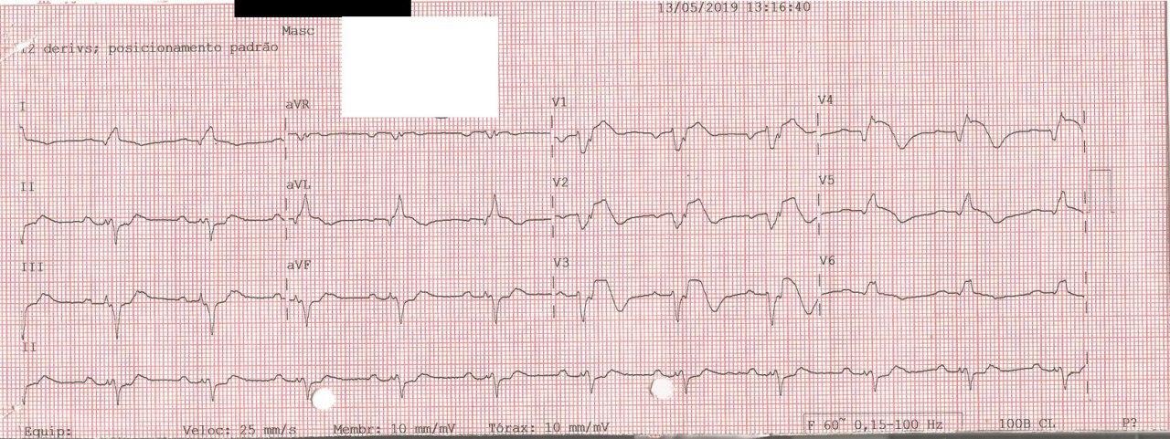 Hombre de 60 años en tratamiento con haloperidol y levomepromazina que desarrolla IAM anterior y BAVC por lesión con trombo en porción proximal de DA y Cx con inestabilidad hemodinámica y mala evolución